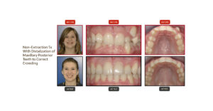 Patient-9-Before-After-Corrected