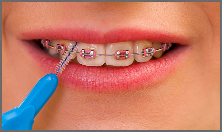 interdental brush ortho